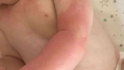一、皮肤红肿与疼痛