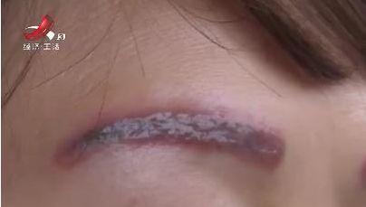 一、激光洗眉红印消退的正常时间