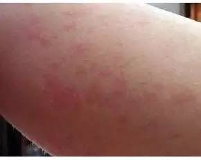 一、认识皮肤过敏