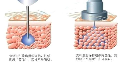 一、钒钛无针水光的原理