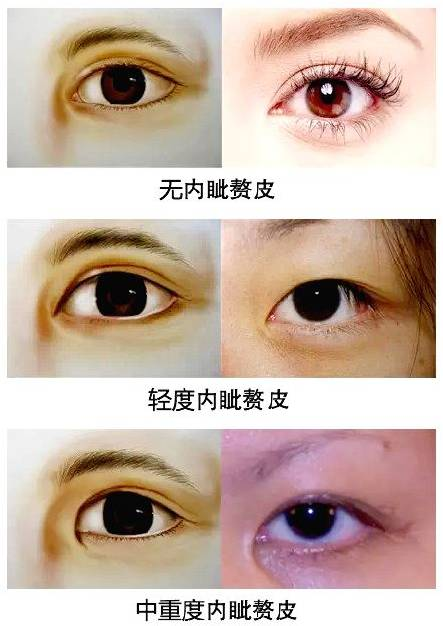 一、开后眼角手术的基本概念