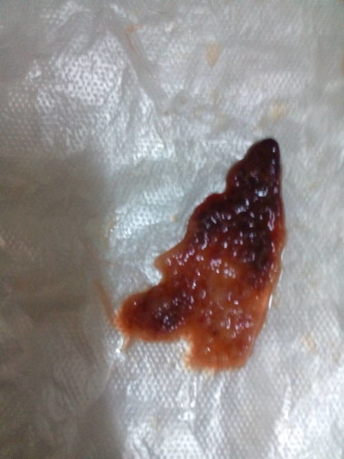 一、拔血罐拔出的血为什么是黑色?