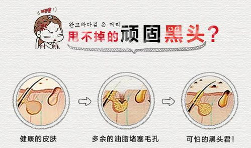 一、黑头贴使用频率解析