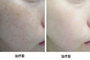 一、光子祛斑原理与结痂现象