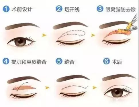 一、全切法双眼皮