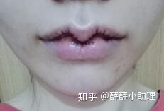 一、了解厚唇改薄手术