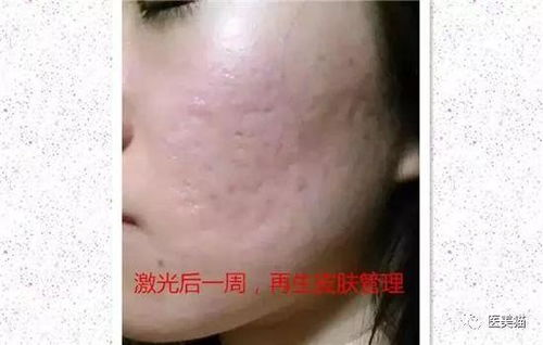 一、激光祛痘印的原理与效果预期