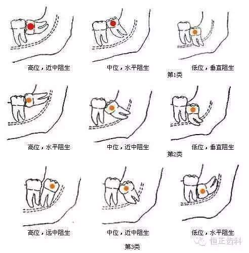 一、拔智齿瘦脸的原理