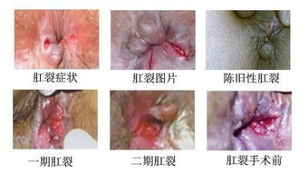 一、新冠咳嗽的常见症状