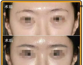 一、了解黑眼圈类型与成因