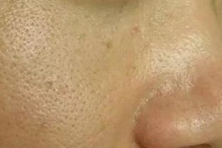 一、了解油性皮肤毛孔粗大的原因