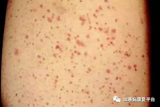 一、了解过敏性皮肤的特性