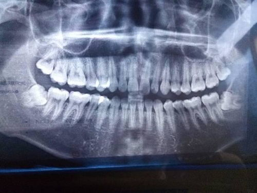 拔智齿的基本费用构成