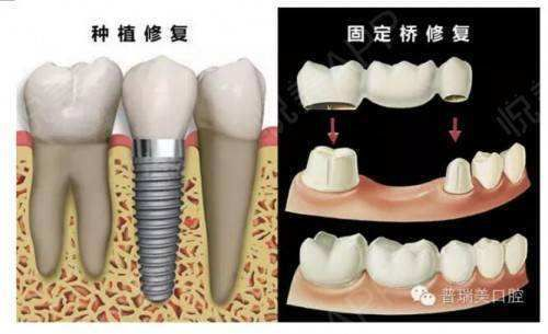补牙费用概述：从基础到高端的价格区间
