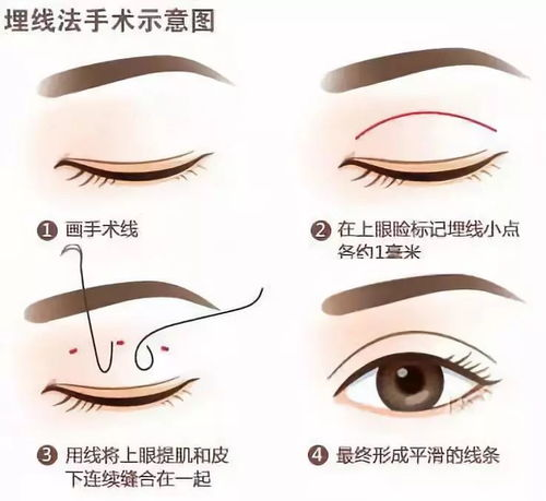 割双眼皮手术的基本价格构成