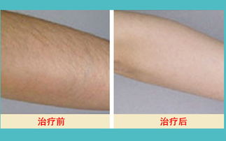 激光脱毛的基本价格构成