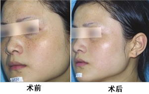 激光去雀斑的基本原理与价格区间
