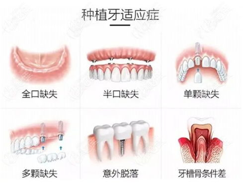 种植牙价格概述