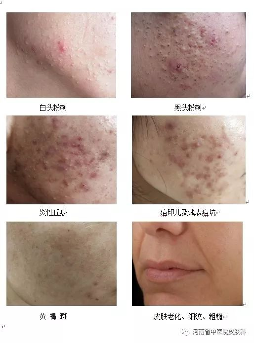 果酸换肤的基本价格范围
