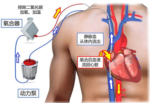 ECMO治疗的基本费用构成