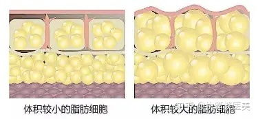 全身抽脂价格构成与基本费用范围