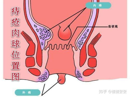 痔疮手术的基本费用构成