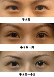 双眼皮手术的基本费用构成