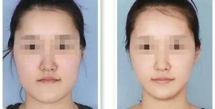 瘦脸针的基本价格构成