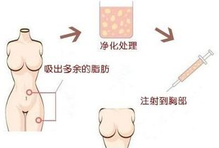 自体脂肪丰胸的基本费用构成