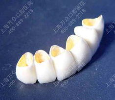 烤瓷牙价格概述