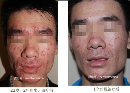果酸换肤的基本概念与价格区间