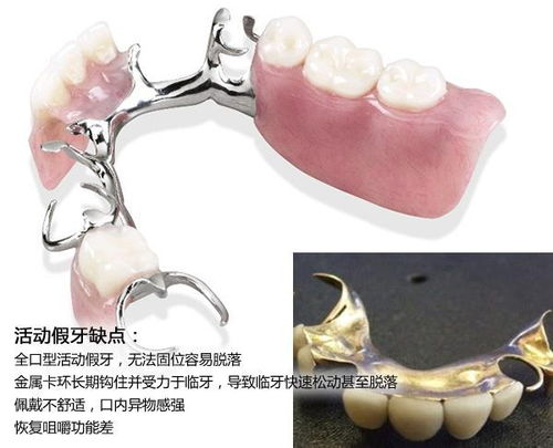 补牙费用的基本构成