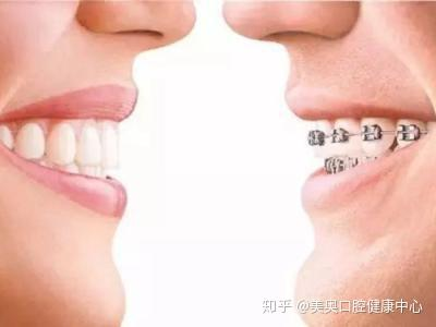 牙齿矫正的价格构成