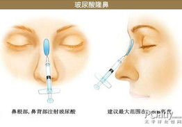 玻尿酸注射价格的基本构成