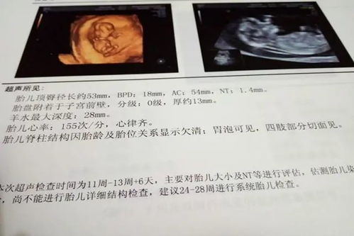 NT检查的基本概念与必要性