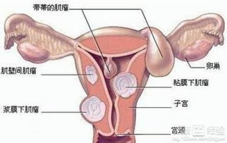 子宫肌瘤手术费用概述