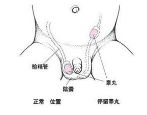 隐睾手术的基本费用构成