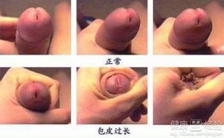 割包皮手术的基本费用构成