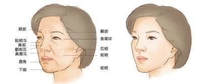填充太阳穴的价格构成