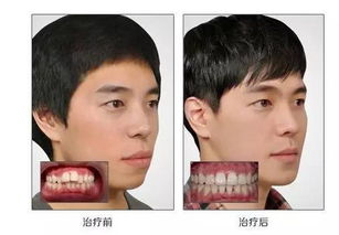 牙齿矫正价格概览