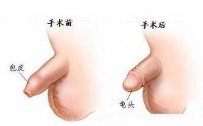 上海割包皮手术价格概览