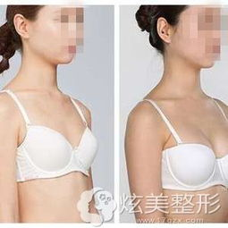 隆胸手术的基本价格构成