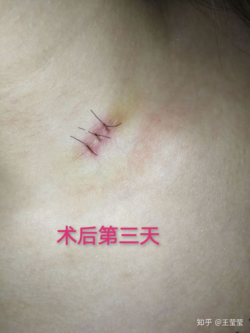 去疤手术的基本费用构成