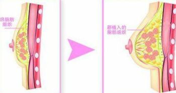 自体脂肪隆胸价格构成解析