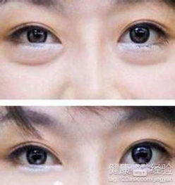 去眼袋手术的基本费用构成