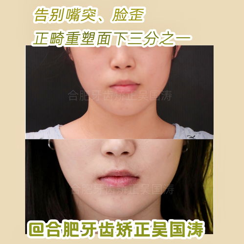 龅牙矫正的基本费用构成