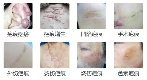 疤痕修复的基本概念与需求