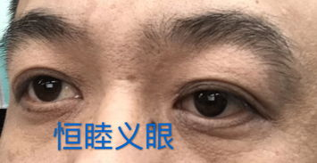 植入义眼的基本费用构成