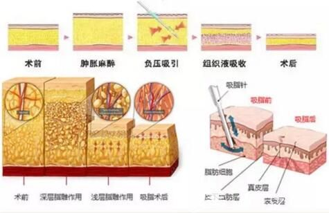 抽脂手术价格构成：基础费用与附加项目