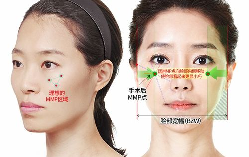 颧骨手术的基本概念与类型
